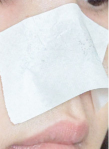  Paper for mask to remove acne (size 10x30 inches)