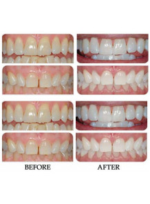 Carbamide Peroxide (44% Gel)
