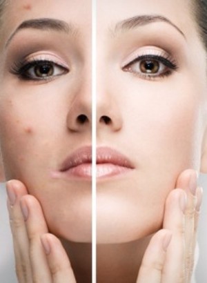 Sebum-Reg™ (Capryloyl Glycine)