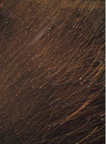 Zinc Pyrithione (Dandruff, Sebderm)