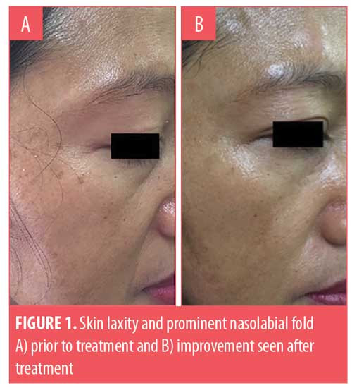 Epidermal Growth Factor (EGF, Recombinant)