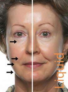 DMAE (SkinTight MD™) Liquid