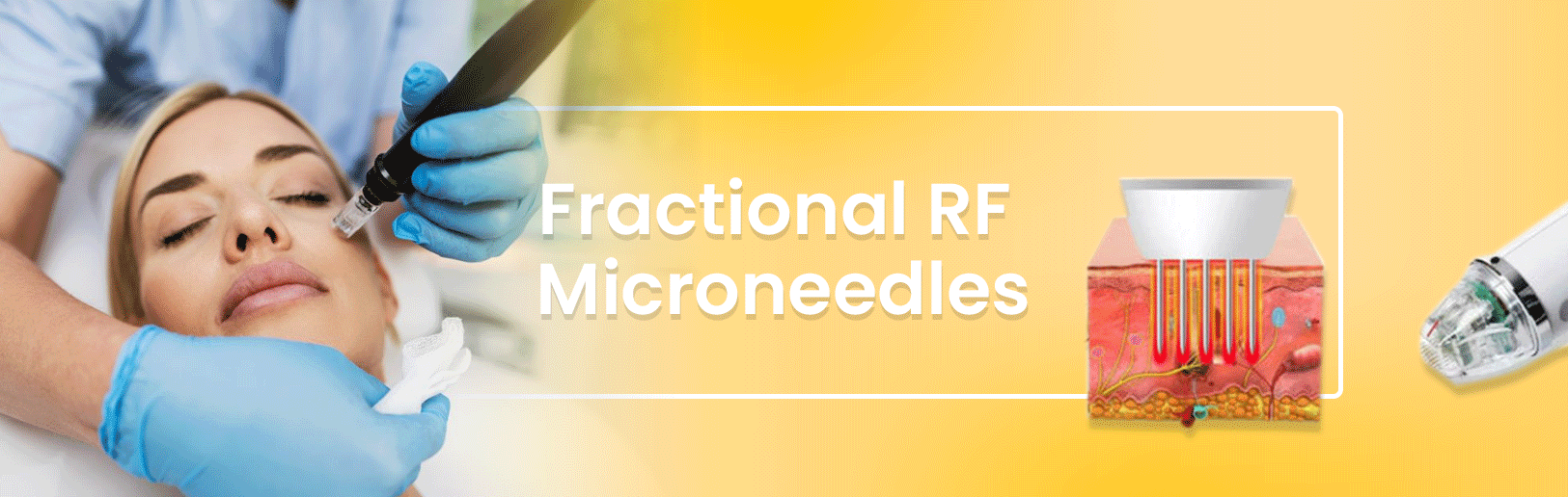 Fractional RF Microneedles